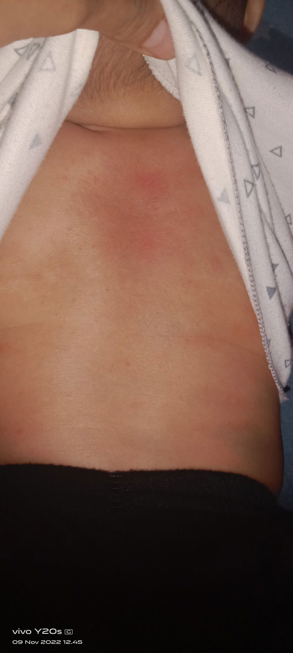 Bercak putih di wajah bayi