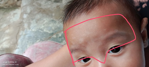 Bercak putih kaya panu