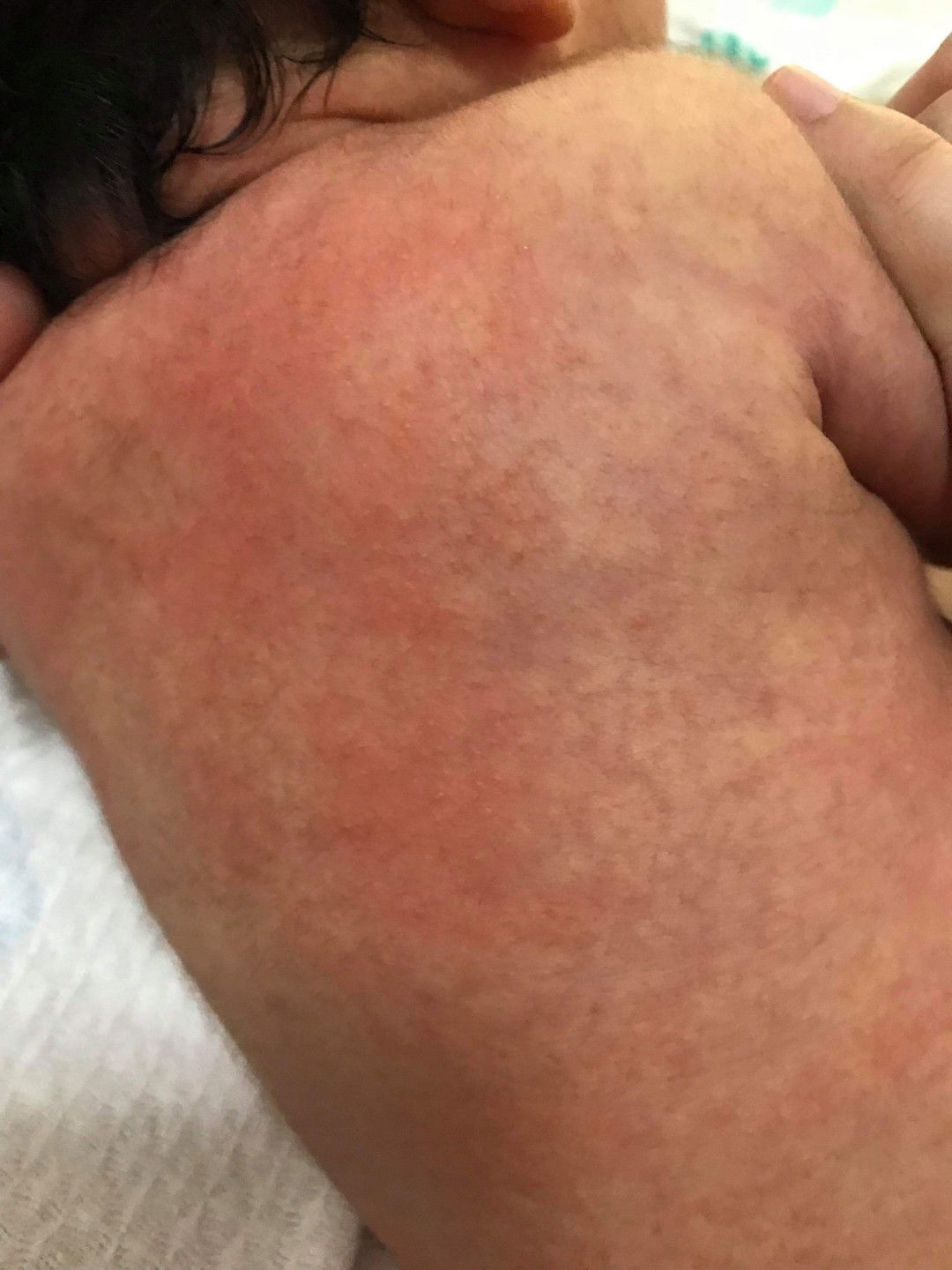 น้องเป็นผื่นอะไรคะ