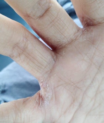 Contact Eczema