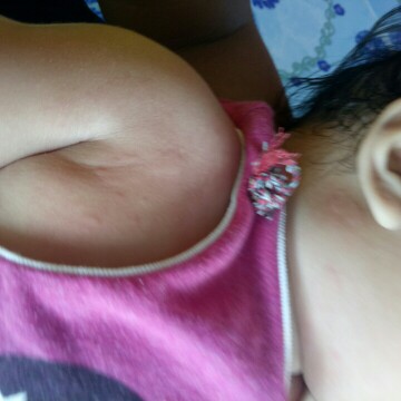 ผื่น