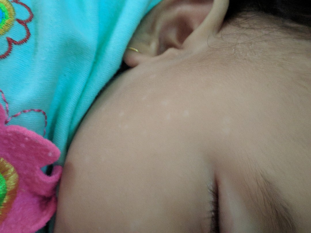 bintik putih di wajah