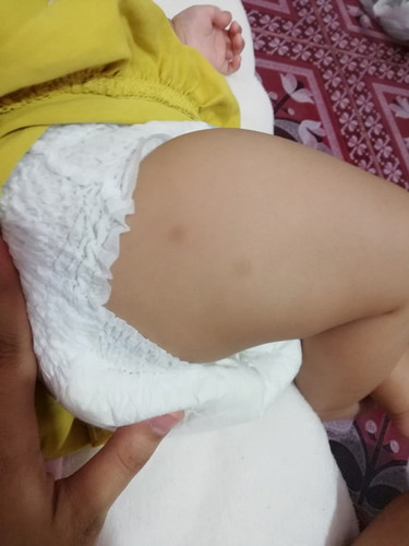 ลอยดำจากยุงกัด