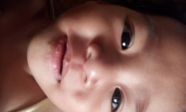dry lips