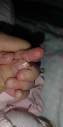 Finger Red And swollen