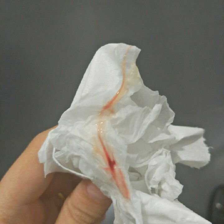 เลือดออกขณะตั้งครรภ์