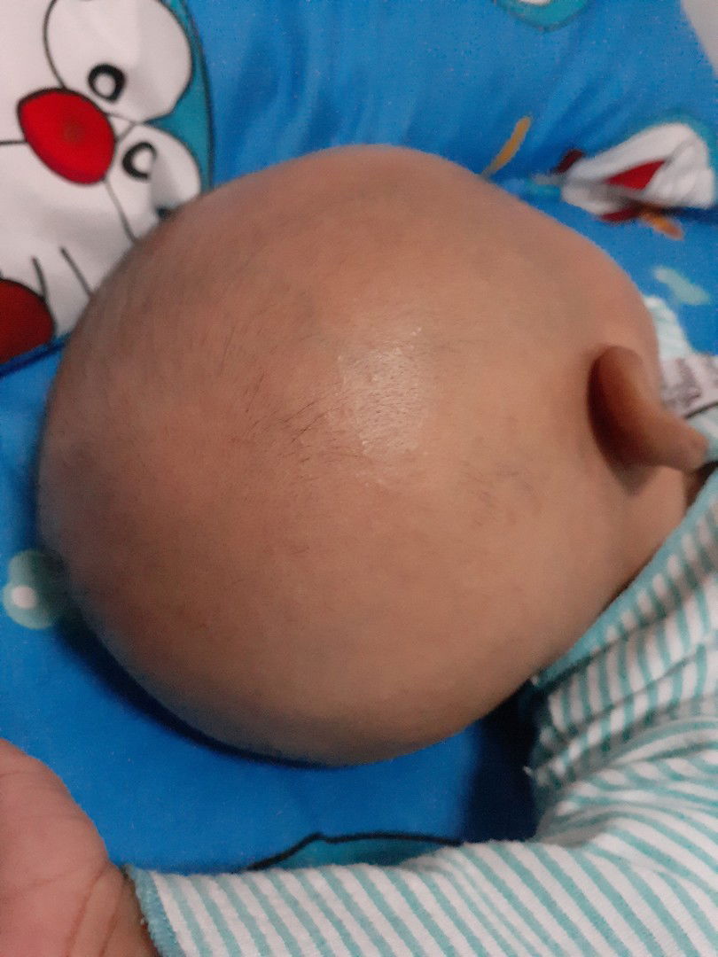 benjolan d kepala anak