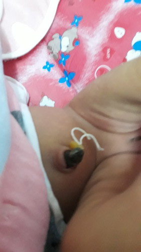 ตรงสะดือมีเหมือนเลือดซึมๆ