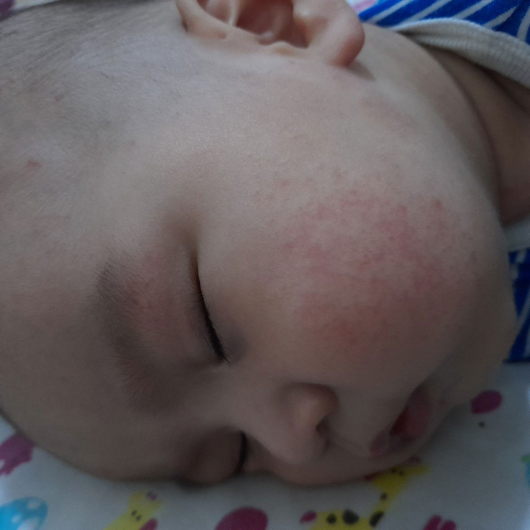 Bagaimana cara mengatasi kulit merah pada wajah bayi?