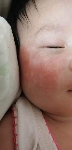 Rashes