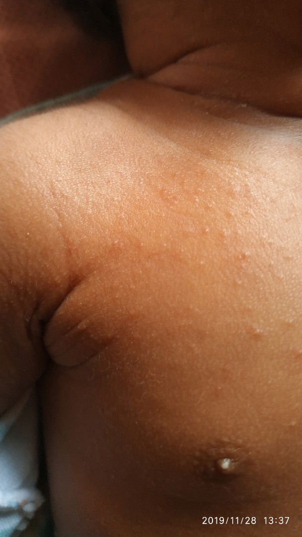 Bruntusan dan puting bintik putih