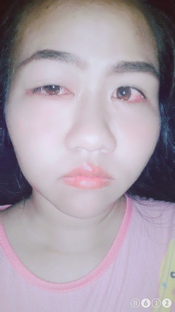 แพ้ของทะเล