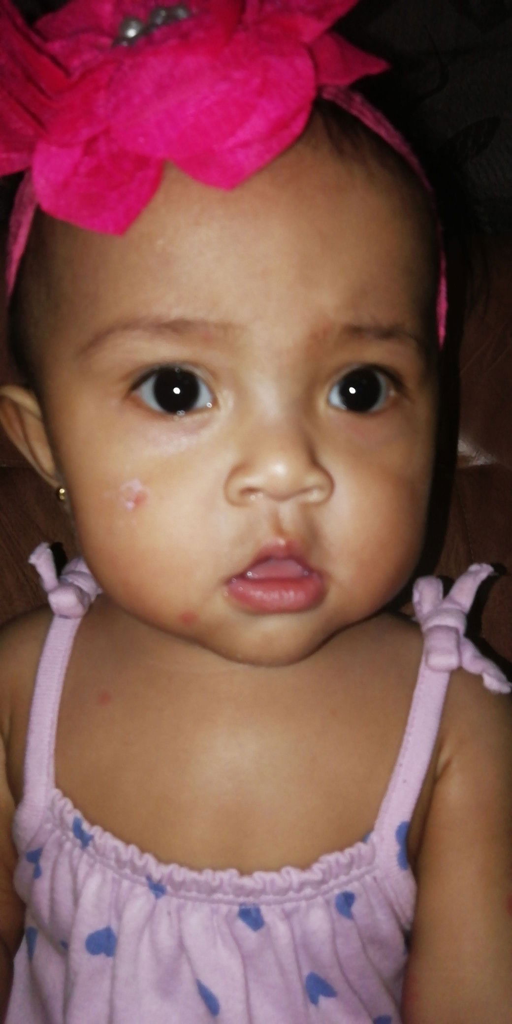 Menghilangkan Bekas Bentol