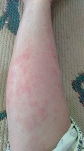 Gatal pasca melahirkan