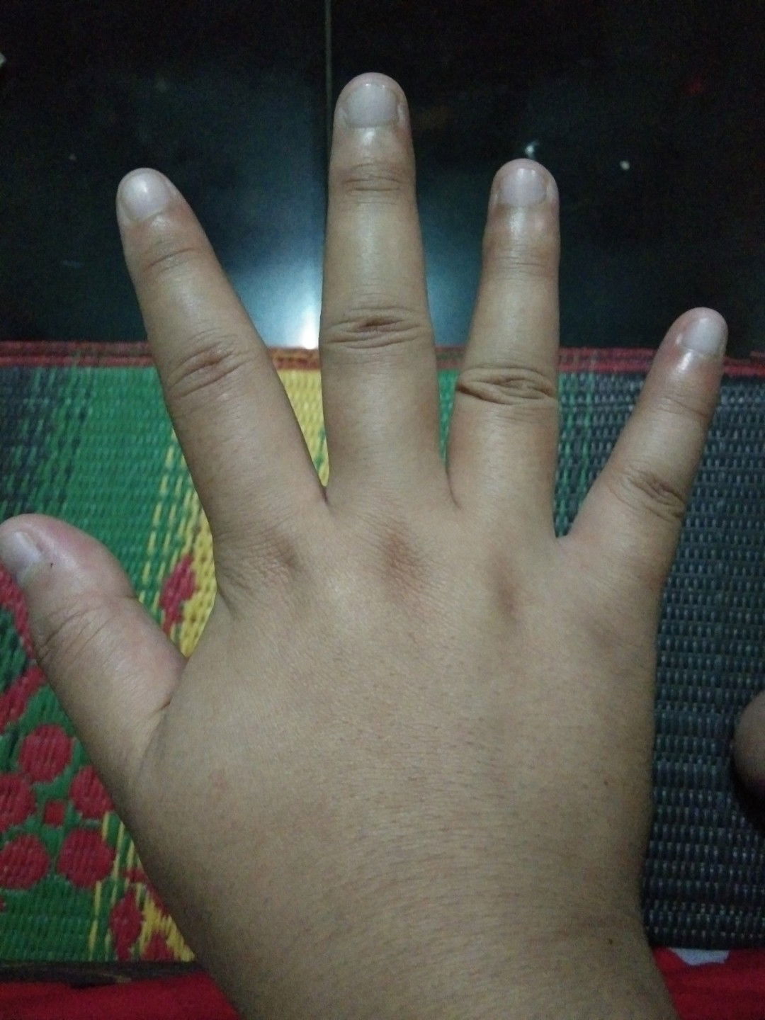 telapak tangan bengkak