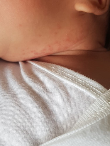 rashes
