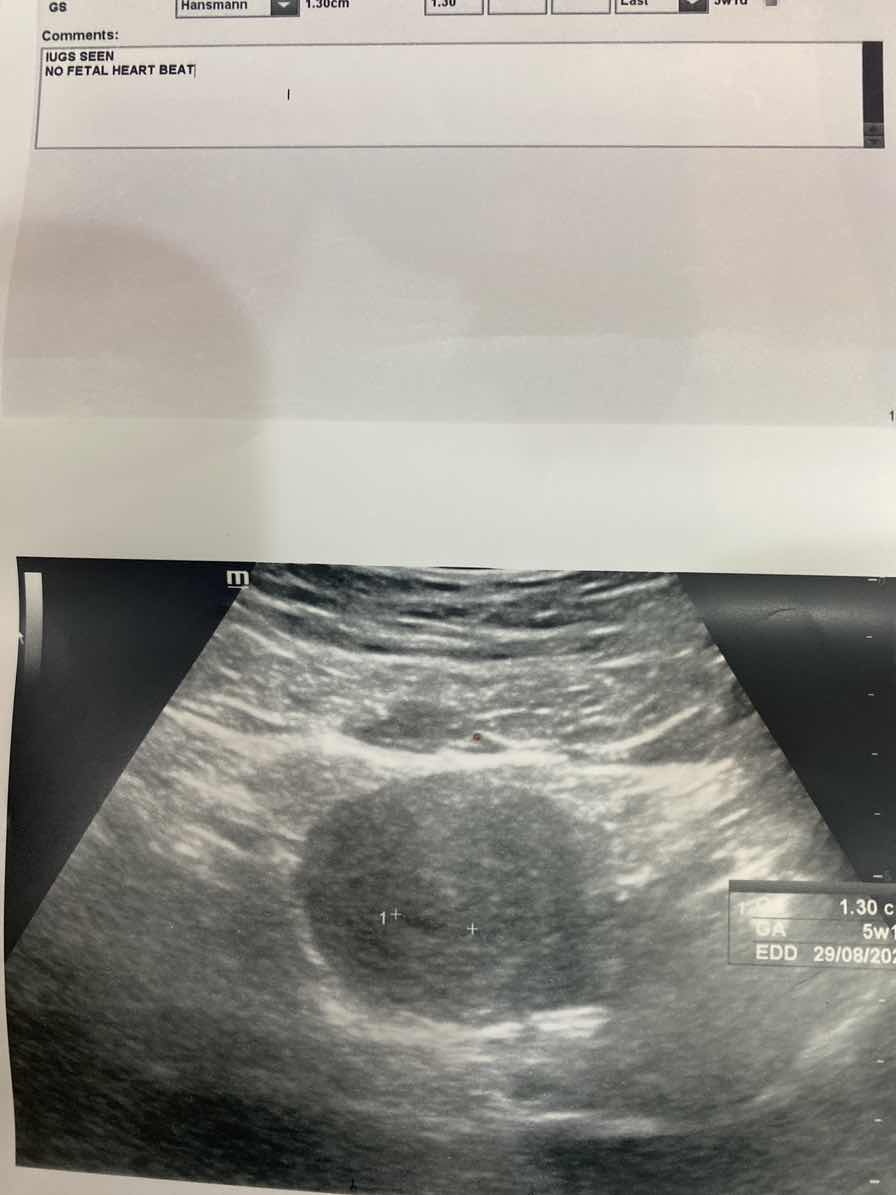 Kantung kosong 7 week