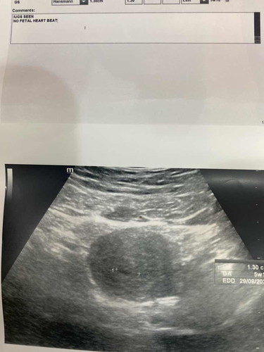 Kantung kosong 7 week