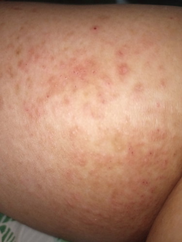 Gatal" pada saat hamil