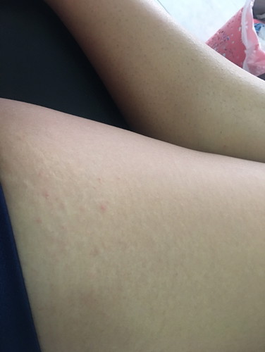 ผื่นขึ้นแบบนี้อันตรายมั้ยค่ะ