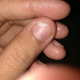 keputihan atau ketuban rembes