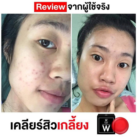 แก้ปัญหาเรื่องสิวว