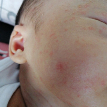 Cradle Cap Or Heat Rash??