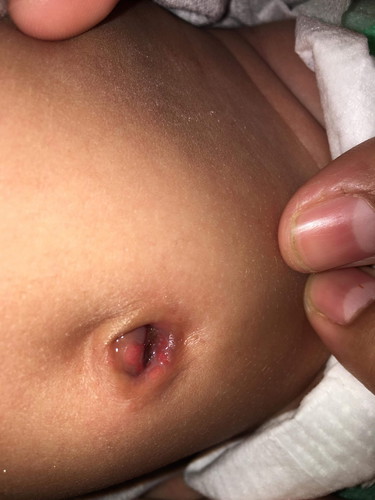 สะดือทารก