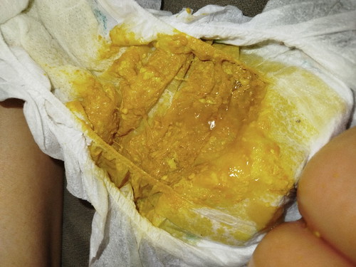 Is this diarrhea?