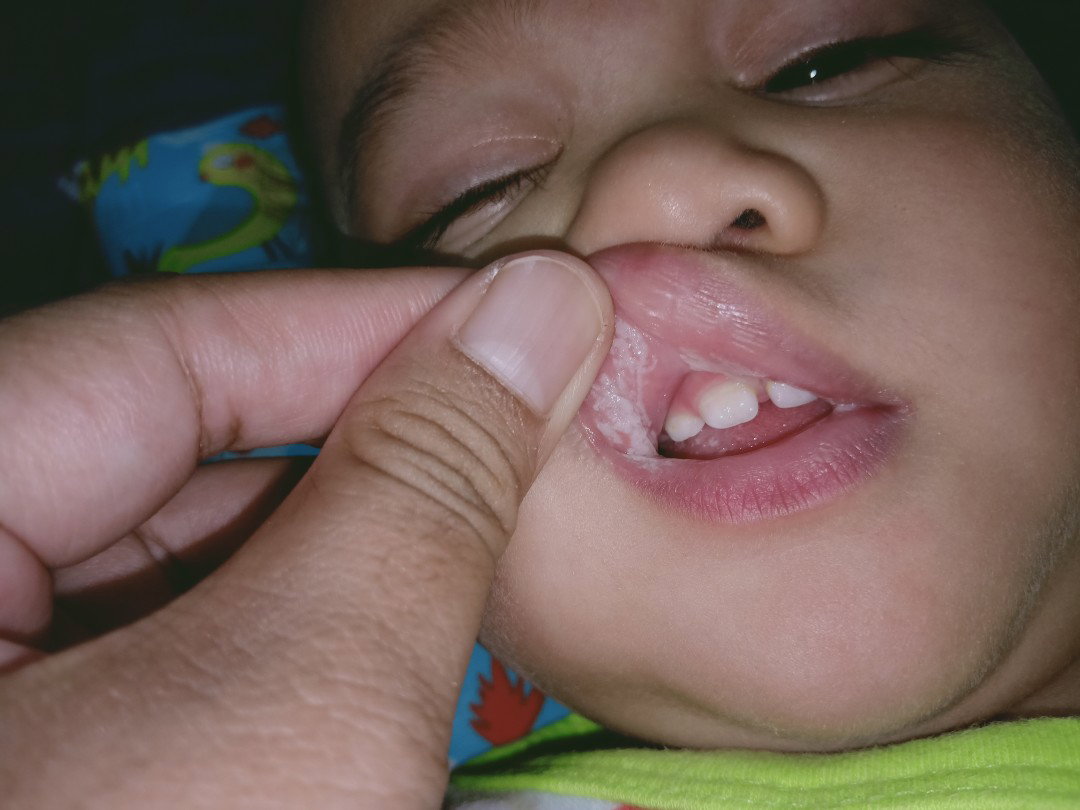 Mulut Bayi Putih