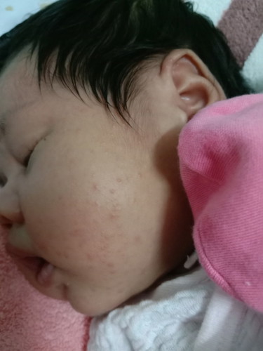 ผดผื่น
