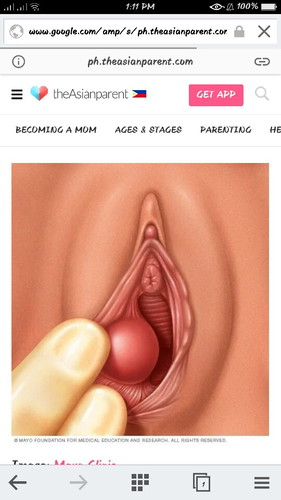 Bartholins Cyst