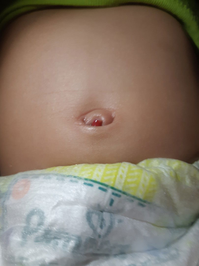 pusat belum kering sampai usia 6 bulan