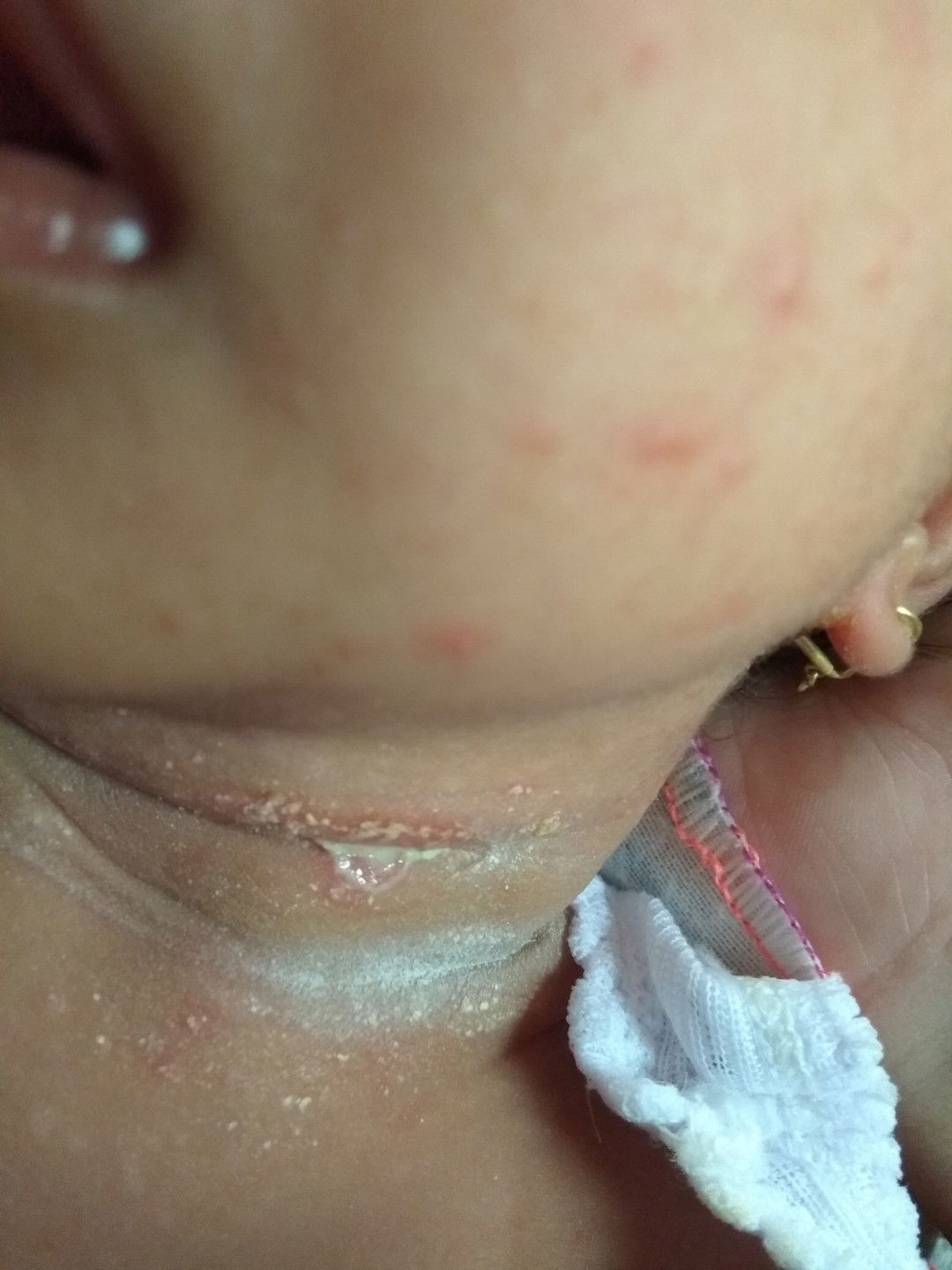 obat untuk leher bayi