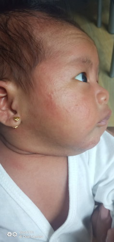 rashes