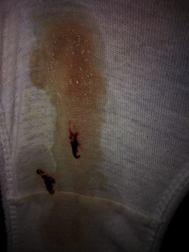 ask lang first time mom, po kz ako ano na po ang ggawin ko my lumabas na po sakin sariwa na buong dugo