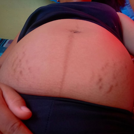 StretchMark