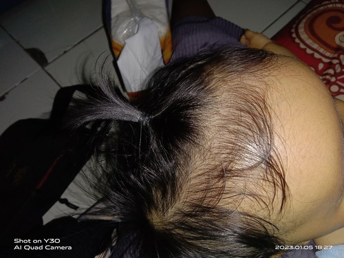 Bun mau tanya,anak saya ktanya lingkar kepalany dgn usian 8 bulan,ktanya terlalu gede,adakah yg sama