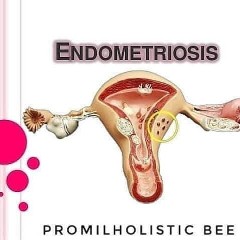 ENDOMETERIOSIS
