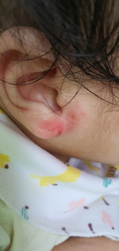 rash?