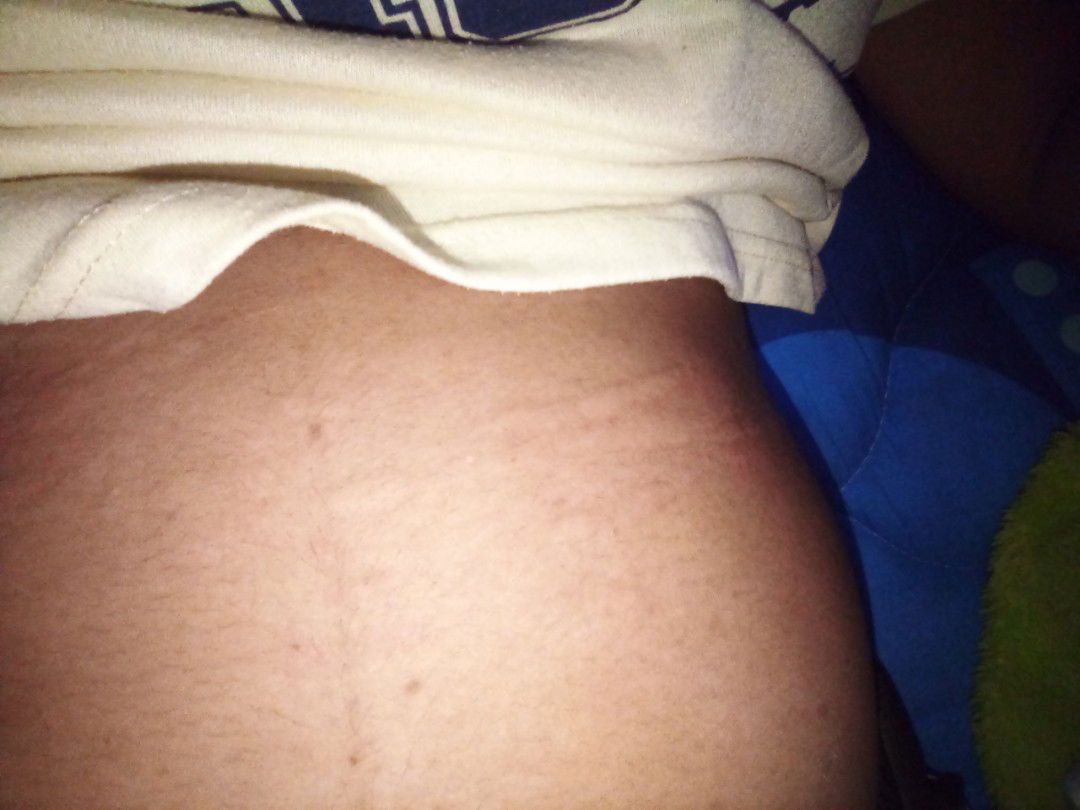 ผื่นคันแม่หลังคลอด