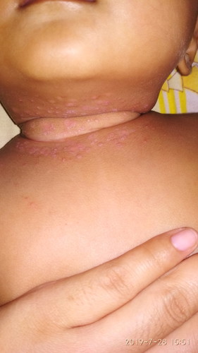 Impetigo