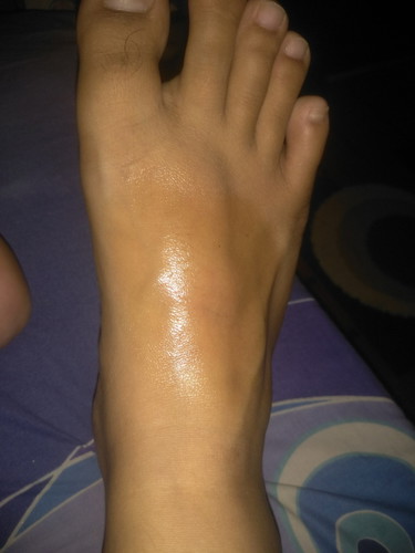 kaki ketimpa ember