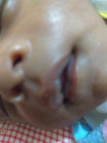 bibir seperti melepuh