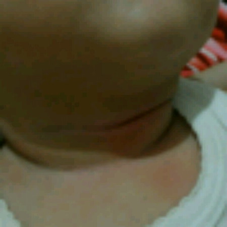 lipatan leher bayi ledes