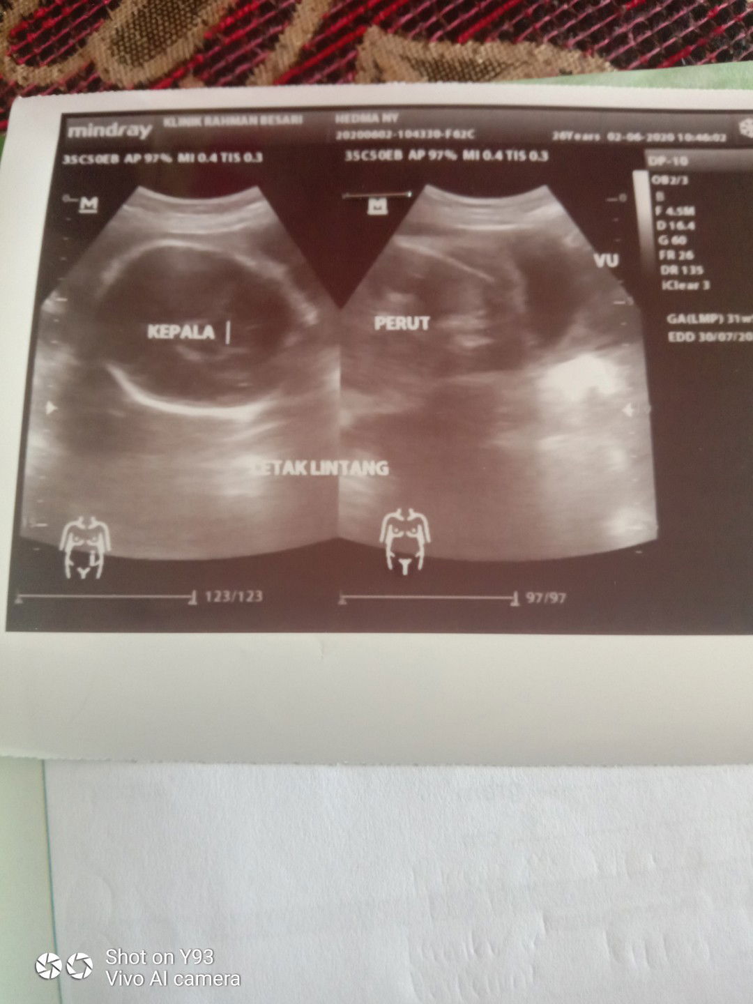 berat janin pas USG