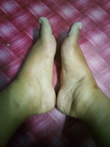 bengkak kaki