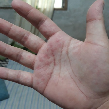 red spots