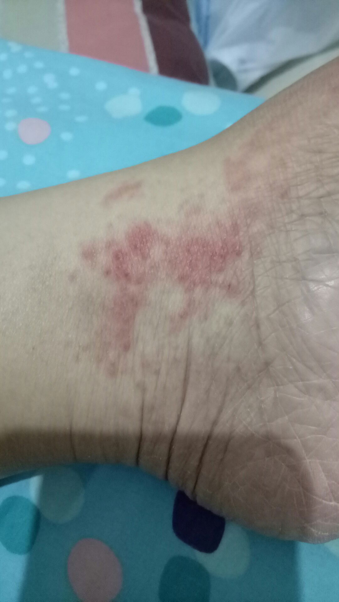 gatal2 seluruh badan,  merah dan nyeri sendi tangan