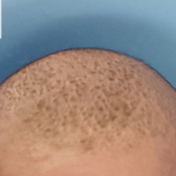 dried skin on the LO head